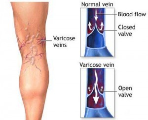 varicose veins