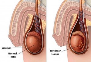 normal testis and testis with lump